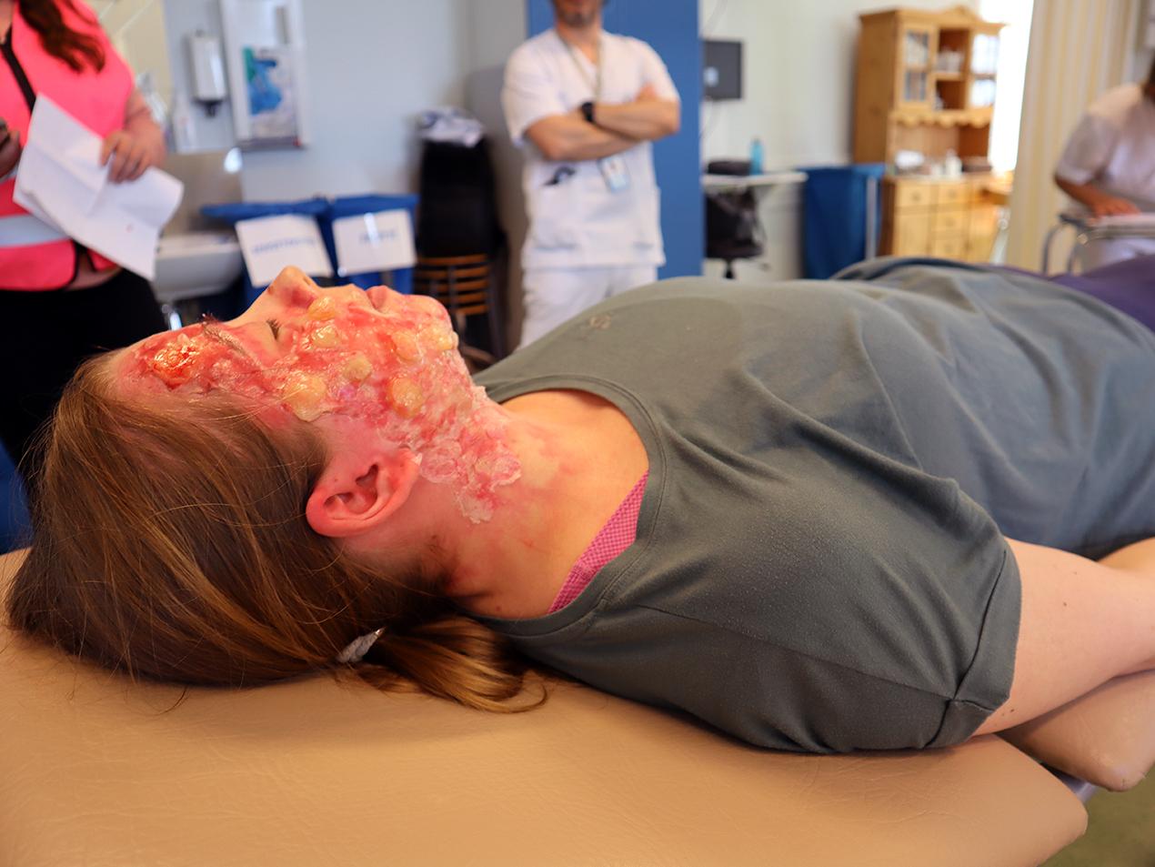 Kvinne med påsminket brannskade i ansiktet ligger på undersøkelsesbenk